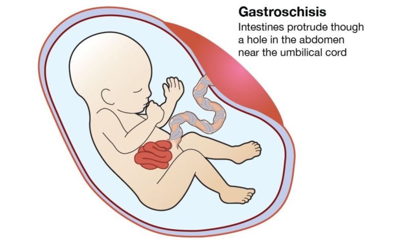 Gastroshiza in Newborns: Causes, Pathophysiology & Treatment