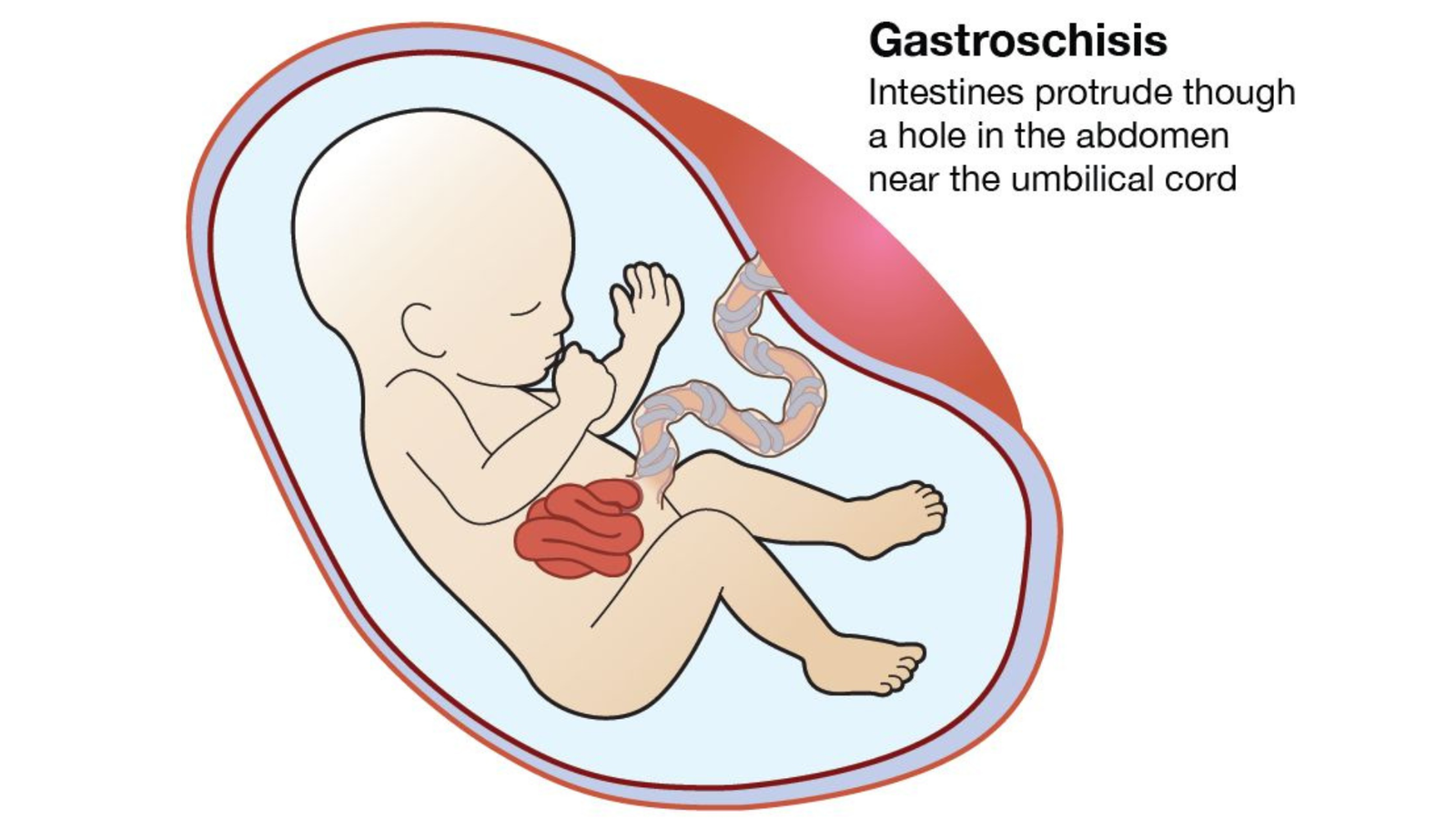 Gastroshiza in Newborns: Causes, Pathophysiology & Treatment